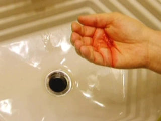 Balgamda Kan Belirtileri ve Tedavisi